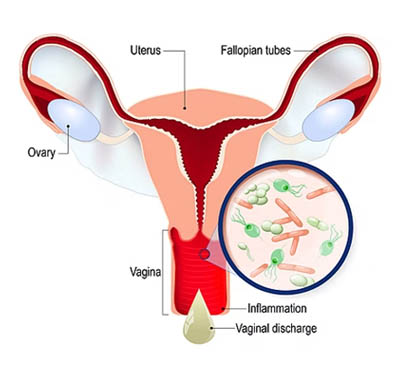 Vaginal Infections Treatment